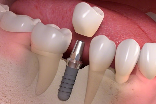 Implantes dental barato